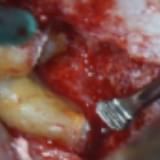 Imagem arredondamento apical, devolvendo o aspecto de como seria o dente em condições normais