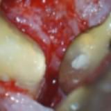 Imagem aspecto final da obturação retrógrada