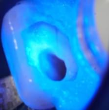 Imagem condicionamento da dentina para posterior aplicação