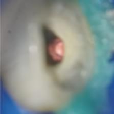 Imagem dente preparado para a instalação do pino