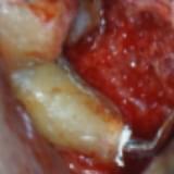 Imagem preenchimento do canal bom biomaterial (MTA) por via retrógrada 