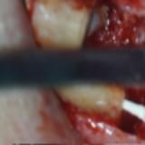 Imagem secagem do conduto por via retrógrada 